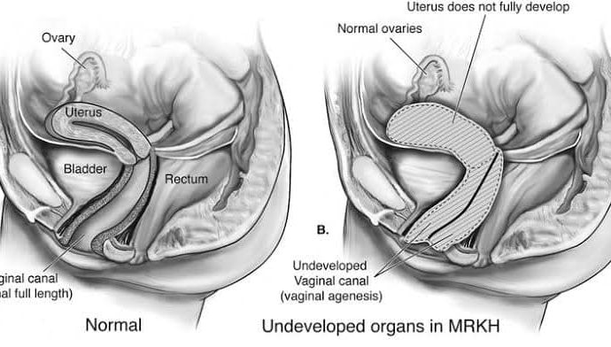 गर्भाशय विकसित नहीं हुआ तब भी लड़की एकदम सामान्य है उसे अपराधबोध में न डालें