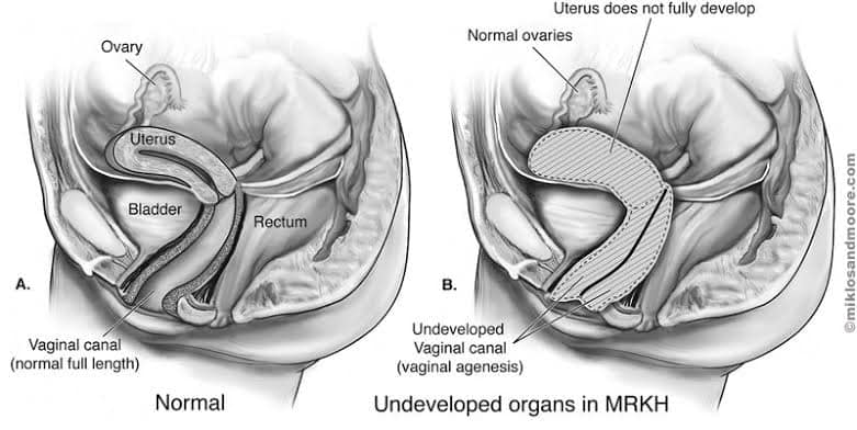गर्भाशय विकसित नहीं हुआ तब भी लड़की एकदम सामान्य है उसे अपराधबोध में न डालें
